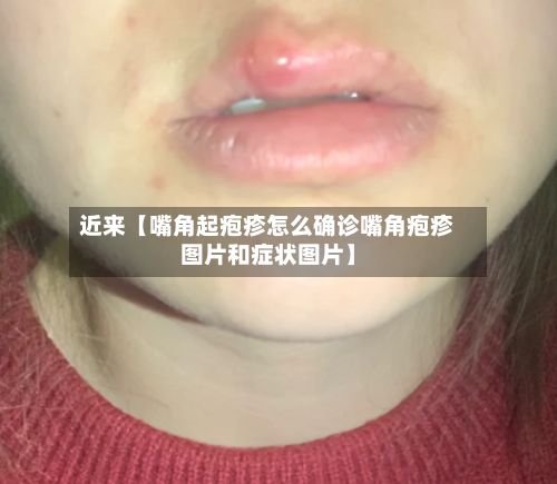 近来【嘴角起疱疹怎么确诊嘴角疱疹图片和症状图片】-第2张图片