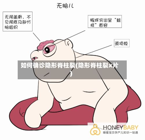 如何确诊隐形脊柱裂(隐形脊柱裂x片)