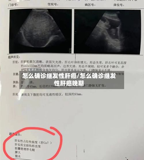 怎么确诊继发性肝癌/怎么确诊继发性肝癌晚期
